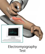 Electromiografia